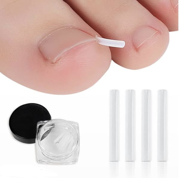 Ingrown Toenail Corrector Pads (10 Pack)