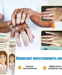 Vitiligo Treatment Cream: Restore Skin Pigmentation