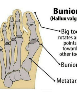 Big Toe Valgus Corrector Set: Full Bunion Protection + Built-in Straightener (Nude Color)